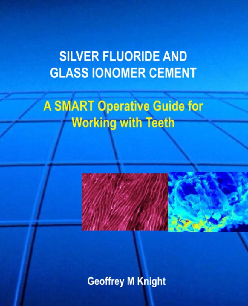 Silver Fluoride and Glass Ionomer Cement A SMART Operative Guide For Working With Teeth